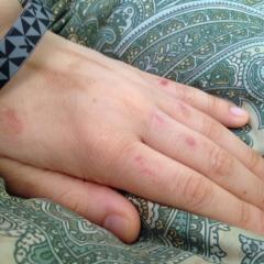 👿障がいと自傷との闘いサムネは実際のtadの自傷の傷ですが😈